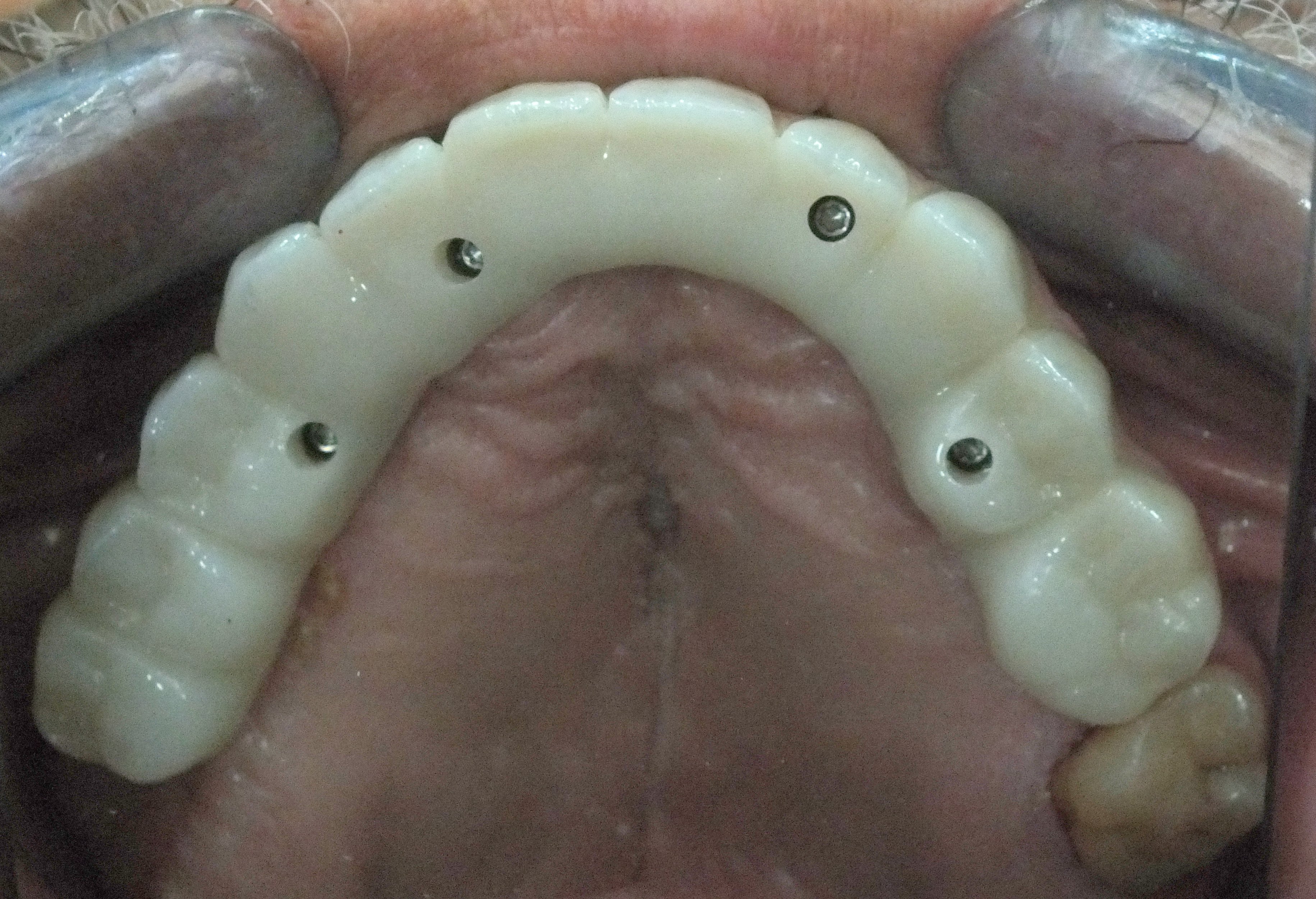 Dental Implants and Restorations