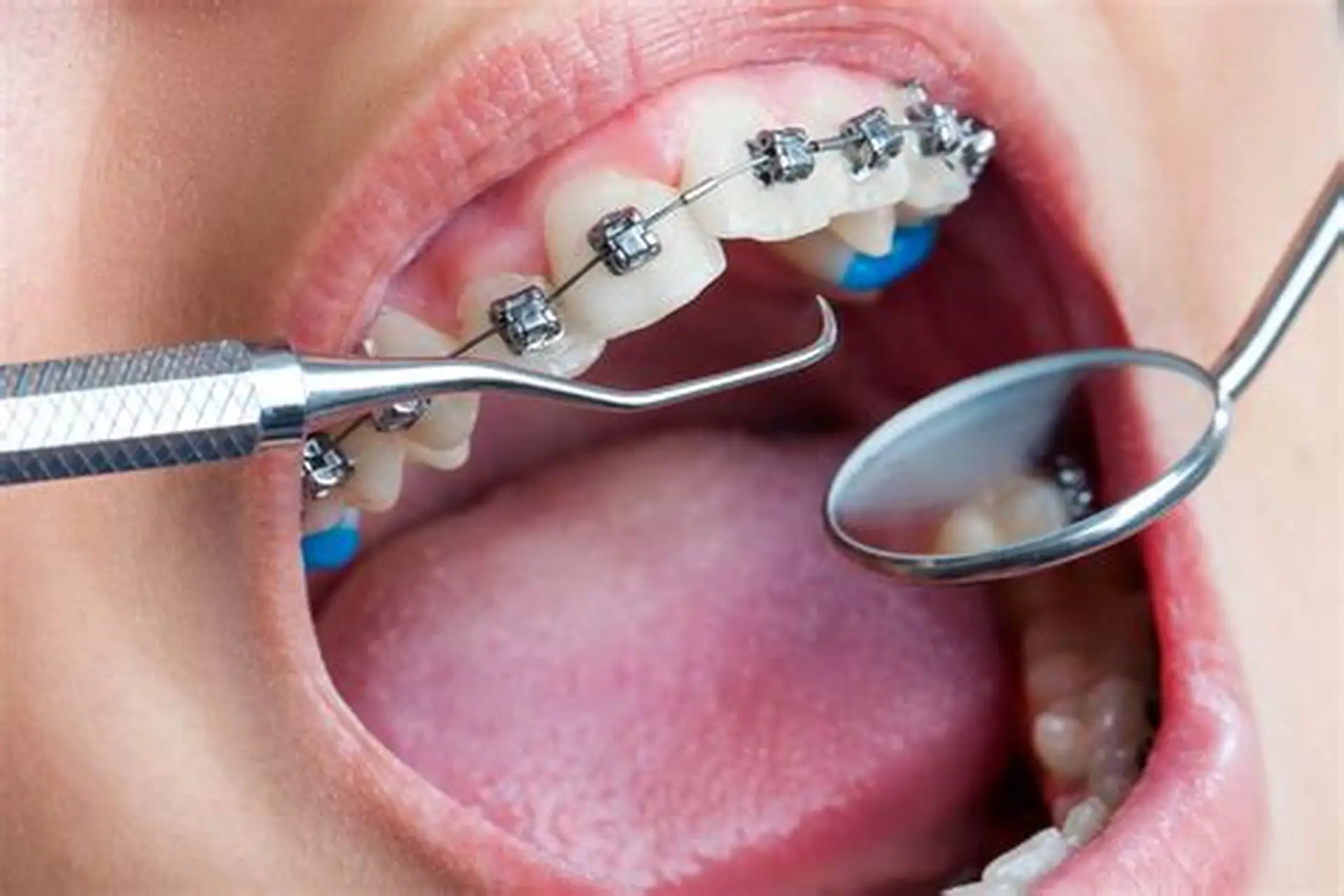 Orthodontic Treatment
